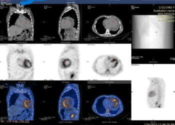 O nouă investigație modernă – scintigrafia cu bifosfonați, în cadrul Laboratorului de Medicină Nucleară al Spitalului Județean Suceava