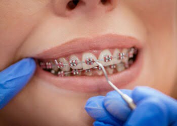 Ai nevoie de aparat dentar dar nu știi ce implică? Iată ce trebuie să reții