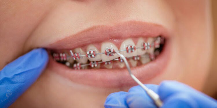 Ai nevoie de aparat dentar dar nu știi ce implică? Iată ce trebuie să reții