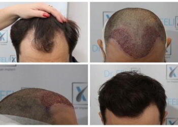 Ce întrebări își pun mai des oamenii despre un implant de păr FUE? Descoperă și tu acum!